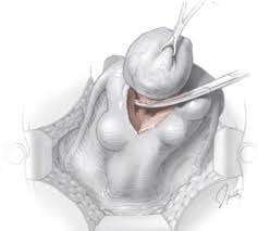 Inner Metamorphosis Copywriter Miomectomy Uterine Fibroids Impact a Woman's Fertility and Pregnancy. Freelance healthy writing wellness formula uterine fibroi symptoms of subserosal fibroid Symptoms from fibroid submucosal fibroids prevent content writing prevent pnekey no cancerous fibroids myomectomy Miomas intramural fibroid inner metamorphosis Histeroscopy early detection content writing complementary associated with infertility abdominal myomectomy