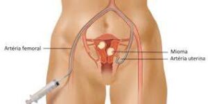 Woman's Fertility and Pregnancy. Uterine Fibroids Impact a Woman's Fertility and Pregnancy.